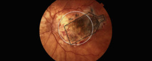 Un implante de retina frena la ceguera causada por la degeneración macular